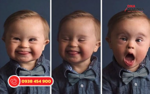 Hội Chứng Down: Hiểu Biết Và Cách Chăm Sóc 11 Hội Chứng Down: Hiểu Biết và Chăm Sóc