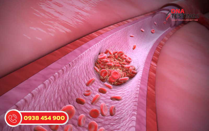 Hiểu Rõ Hơn Về Hội Chứng Thrombophilia Tăng Đông Máu