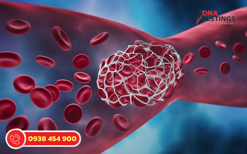 Hiểu Rõ Hơn Về Hội Chứng Thrombophilia Tăng Đông Máu