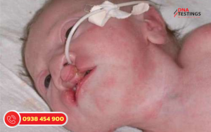 Hội Chứng Patau (Trisomy 13): Thông Tin, Triệu Chứng và Lời Khuyên 7 Hội Chứng Patau (Trisomy 13): Thông Tin, Triệu Chứng và Lời Khuyên