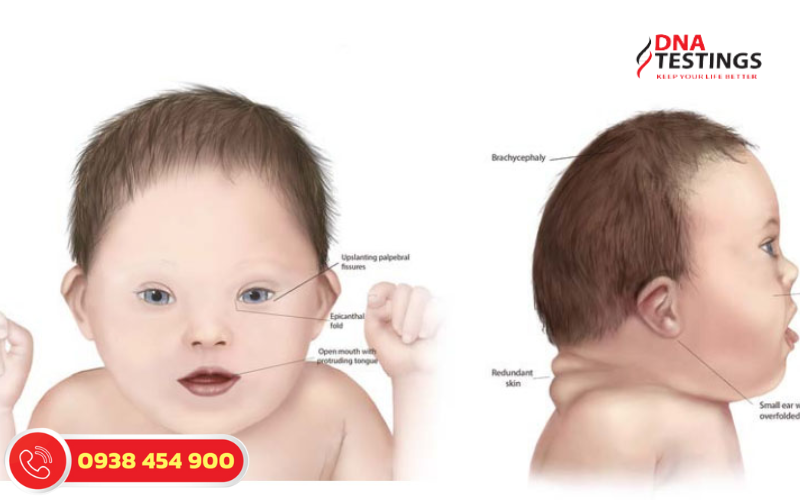 Những Điều Cần Biết Về Hội Chứng Down (Trisomy 21)