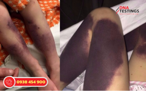 Hiểu Rõ Hơn Về Hội Chứng Thrombophilia Tăng Đông Máu 5 Hiểu Rõ Hơn Về Hội Chứng Thrombophilia Tăng Đông Máu