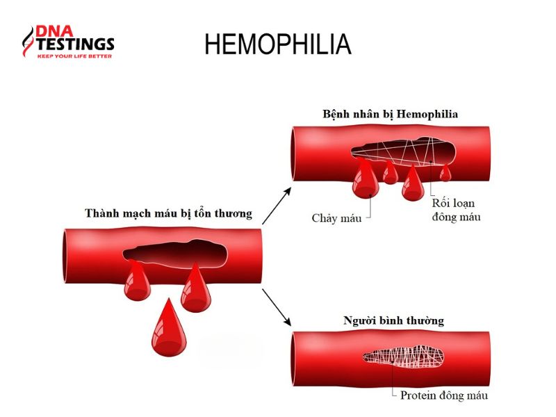 Tìm hiểu về xét nghiệm gen Hemophilia
