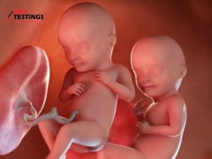 Xét nghiệm NIPT cho thai đôi cần lưu ý những gì? 10 Xét nghiệm NIPT cho thai đôi cần lưu ý những gì?