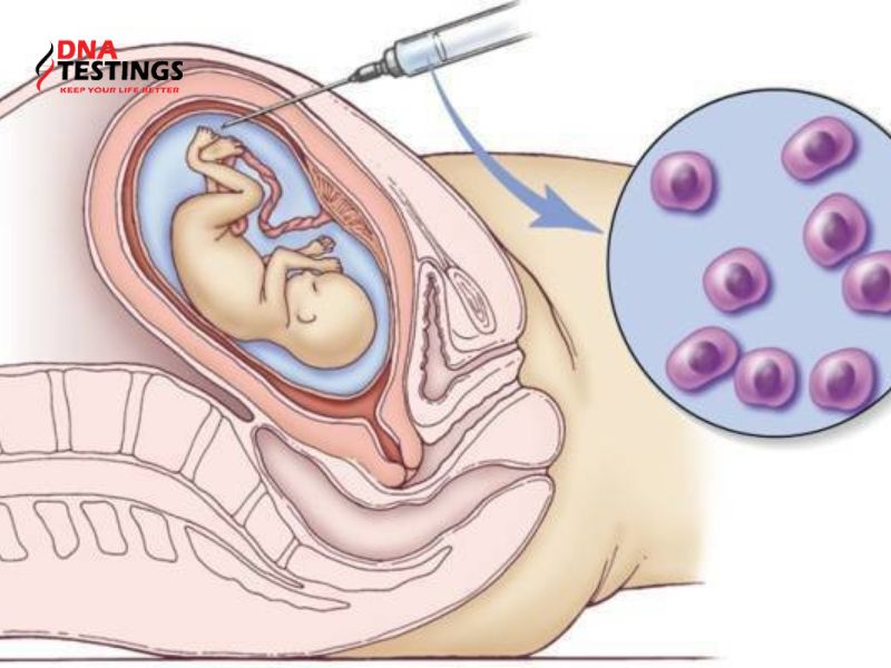 Xét nghiệm QF-PCR chẩn đoán trước sinh