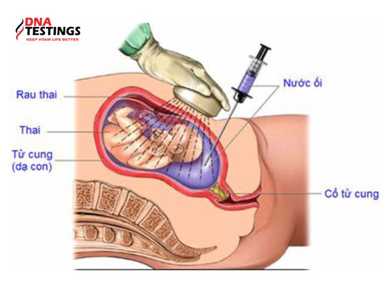 Xét nghiệm QF-PCR chẩn đoán trước sinh