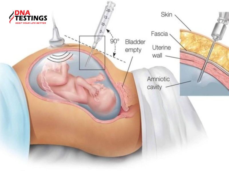 Kinh nghiệm đi chọc ối: Những điều cần biết và chuẩn bị