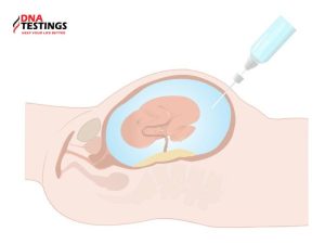 Những điều mẹ bầu cần biết về chọc nước ối xét nghiệm bệnh Down 21 Những điều mẹ bầu cần biết về chọc nước ối xét nghiệm bệnh Down