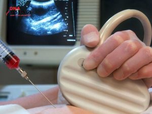 Chọc ối có an toàn không? Những có có thể thực hiện chọc ối 11 Chọc ối có an toàn không? Những có có thể thực hiện chọc ối