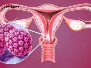 Chủng HPV 51 là gì? Có chữa được không? Phòng ngừa thế nào? 10 Chủng HPV 51 là gì? Có chữa được không? Phòng ngừa thế nào?