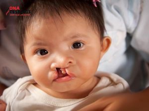 Tìm hiểu mức độ nguy hiểm của hội chứng DiGeorge 10 Tìm hiểu mức độ nguy hiểm của hội chứng DiGeorge