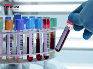 Làm xét nghiệm Double Test có cần nhịn ăn không? 9 xét nghiệm Double Test